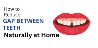 How to Reduce Gap Between Teeth Naturally at Home How to Reduce Gap Between Teeth Naturally at Home