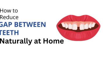 How to Reduce Gap Between Teeth Naturally at Home How to Reduce Gap Between Teeth Naturally at Home