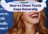 Restore Confidence By Closing The Gaps Between Teeth With Simple Restore Confidence By Closing The Gaps Between Teeth With Simple